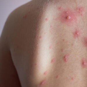 Hidradenitis supurativa